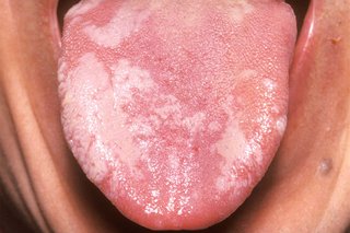 A person sticking their tongue out. There are a number of white patches on their tongue that are an irregular shape.