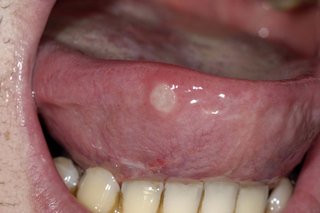 A large, white, circular mouth ulcer on the underside of the tongue.