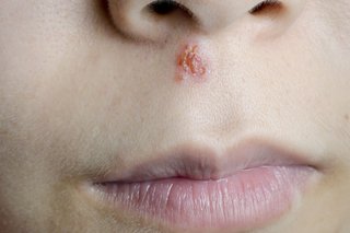 Cold sore on face just below the nose on someone with white skin.