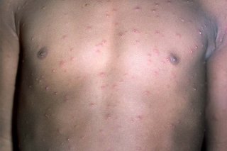 About 80 pink chickenpox spots and blisters on the chest and arms. Some blisters are shiny. Shown on light brown skin.