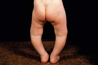 A child with bowed legs. Their legs are curved and there's a large gap between their knees.