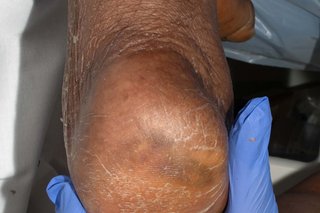 A pressure ulcer on the heel of someone with dark brown skin. The skin appears raised, dry and cracked.