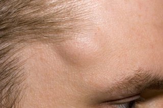 A lipoma under the skin of the forehead of someone with white skin. The lipoma is a few centimetres wide.