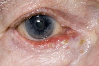 Close-up of a person's eye with ectropion. The lower eyelid is red, sore-looking and turned outwards.