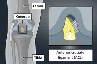 A diagram showing where the ACL (anterior cruciate ligament) is inside the knee.